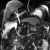 MRI abdomen showing pancreatic necrosis compressing on the common bile duct.