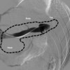 Splenic vein venography.