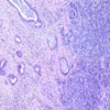 Mixture of usual cholangiocarcinoma (left part of the picture) and small cell neuroendocrine carcinoma (right part).