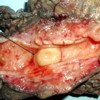 Nodular mass in the common bile duct lumen.