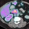 PET CT image shows diffuse uptake of contrast in the head of the pancreas.