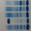 A sharp M band in the gamma-globulin region detected on serum protein electrophoresis.