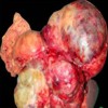 Gross specimen showing a large lobulated tumor in relation to the body and tail of the pancreas which showed cystic and hemorrhagic degeneration.