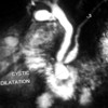 MRCP showing cystic dilation of terminal part of main pancreatic duct.