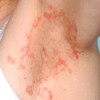 Dermatosis affecting the axilla