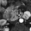 Contrast enhanced MRI of pancreatic adenocarcinoma