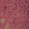 Representative staining pattern observed in cases tropical calcific pancreatitis H&E)