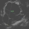 Linear EUS image showing the anechoic cyst with several thin septae.