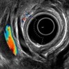 Radial EUS: stack sign showing common bile duct, pancreatic duct and portal vein.