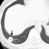 Chest CT before lung resection revealed a 1.5 cm, nodular opacity with spicula in the right lung segment 10.